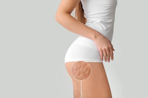 CELLULITE